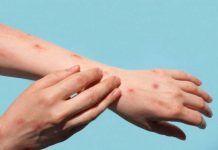 अमेरिकेत मंकीपॉक्स सार्वजनिक आरोग्य विषयक आणीबाणी म्हणून जाहीर