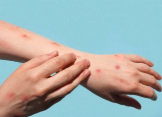 अमेरिकेत मंकीपॉक्स सार्वजनिक आरोग्य विषयक आणीबाणी म्हणून जाहीर