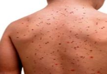 मुंबईसह महाराष्ट्रात गोवर संसर्गजन्य आजाराच्या प्रादुर्भावात वाढ