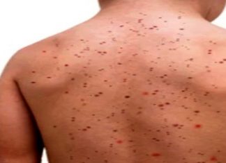 मुंबईसह महाराष्ट्रात गोवर संसर्गजन्य आजाराच्या प्रादुर्भावात वाढ